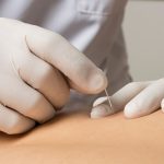 Punción seca en fisioterapia