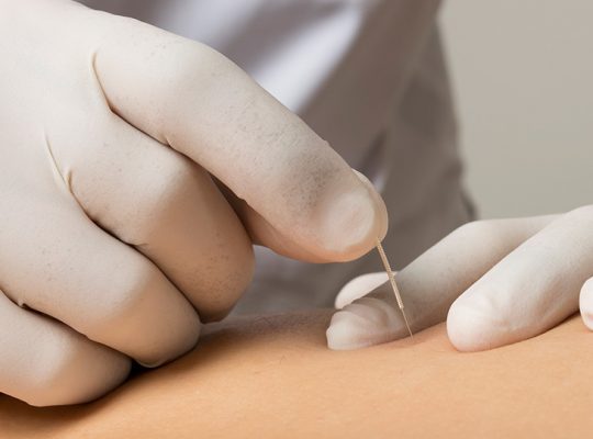 punción seca en fisioterapia