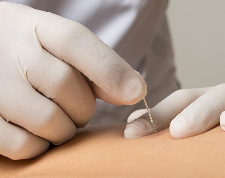 punción seca en fisioterapia