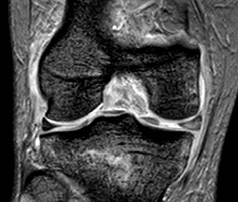 ligamento cruzado posterior