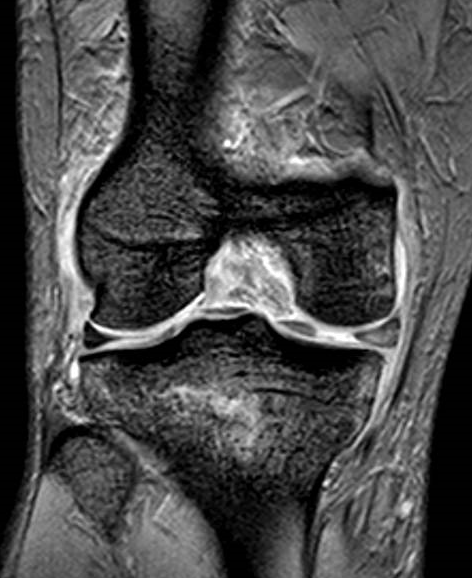 ligamento cruzado posterior