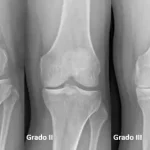 Osteoartritis de rodilla, ¿adiós a correr?
