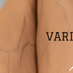 Alivia las Varices con un Tratamiento Activo de Fisioterapia